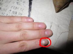导致灰指甲复发的原因有哪些呢